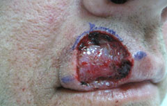 Case Study - Mohs Surgery Patient in Sarasota Florida