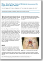 Malar Butterfly Flap: Bilateral Melolabial Advancement for Large Dorsal Nasal Defects