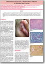 Retroauricular Ulcer in a Patient with a History of Multiple Skin Cancers